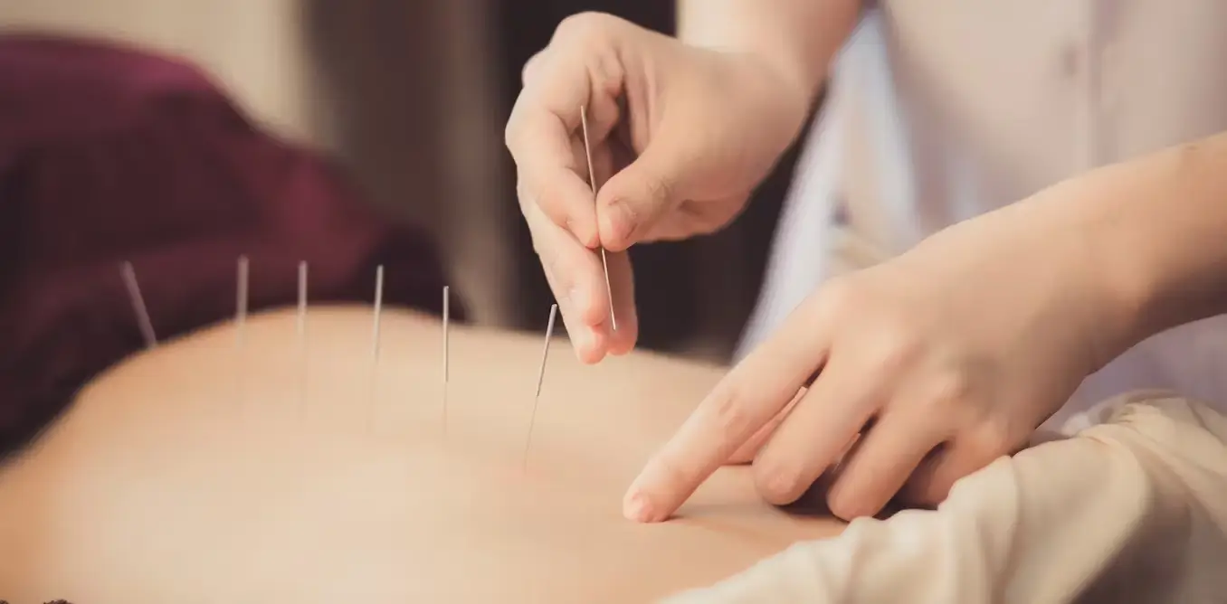 AcupunctureInChennai