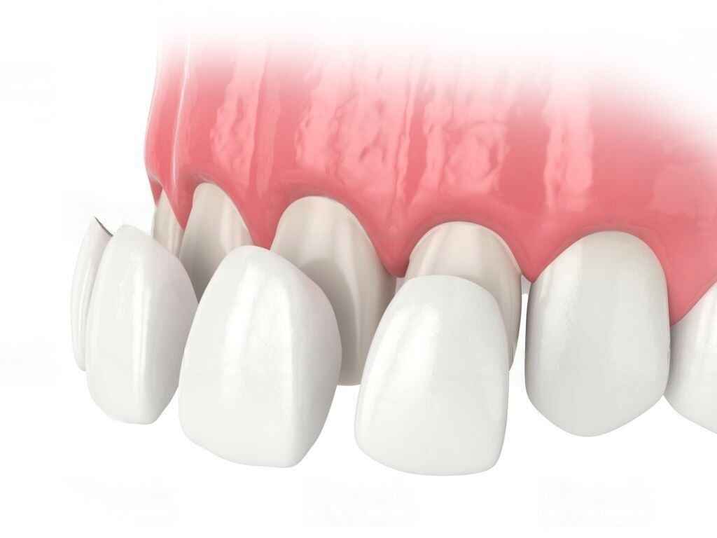 Dental Crowns and Bridges in Abu Dhabi