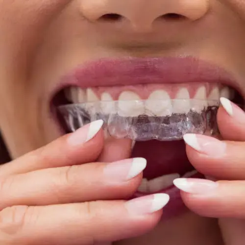 Invisalign® Treatment in Ahmedabad